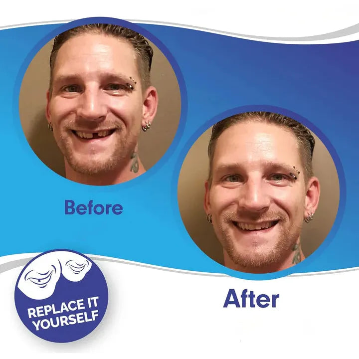 Smile Veneer (Upper & Lower Included)