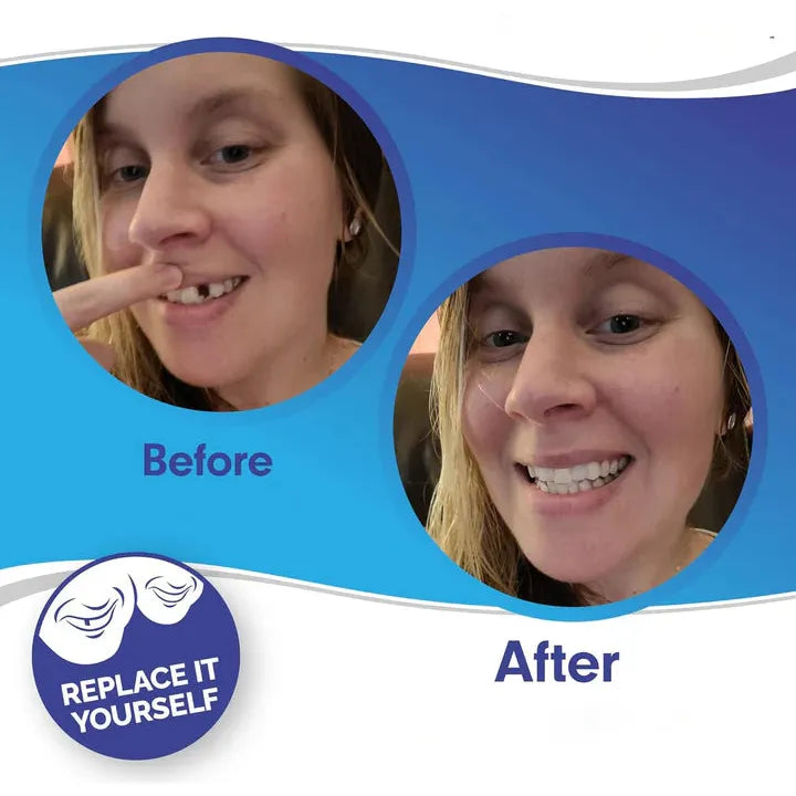 Smile Veneer (Upper & Lower Included)