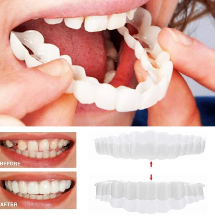 Smile Veneer (Upper & Lower Included)